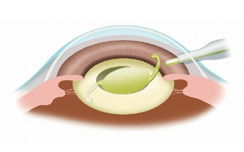 眼内レンズを挿入